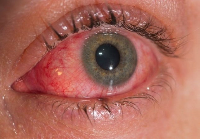 Conjuntivitis en Margarita - Artículo sobre la conjuntivitis alérgica Conjuntivitis en Margarita - Artículo sobre la conjuntivitis alérgica